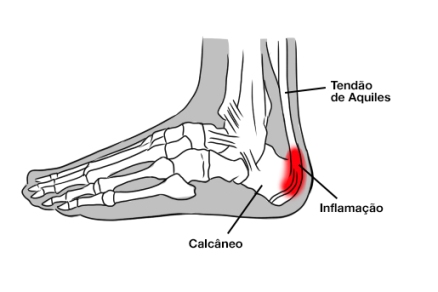 dor no calcanhar 2