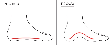 dor no arco do pé cavo chato