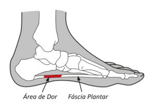 dor arco pé fascite plantar fascia